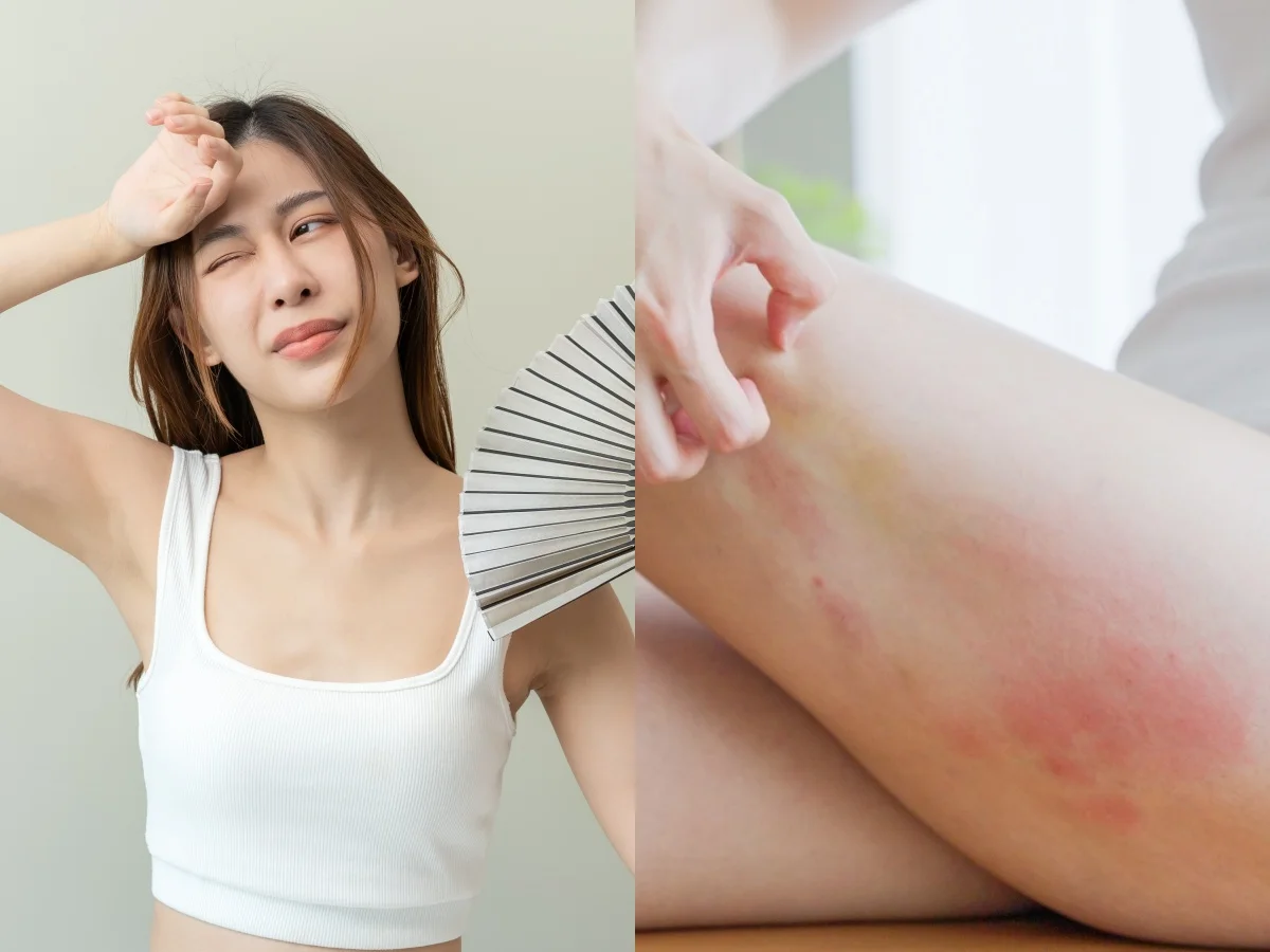 夏天濕疹狂爆發不是體質差!醫師點名3個日常習慣,照做癢感秒降、皮膚穩定一整季
