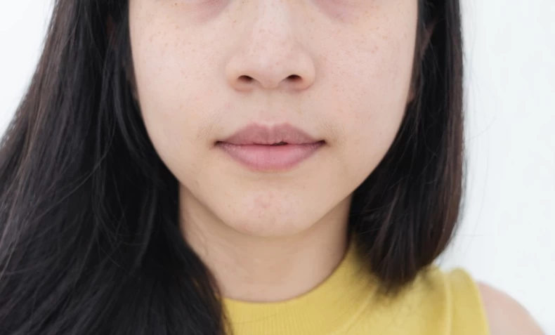 唇周暗沉改善
