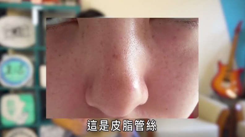 妳超愛拔粉刺的爽感？別傻了！其實妳拔的根本不是粉刺...
