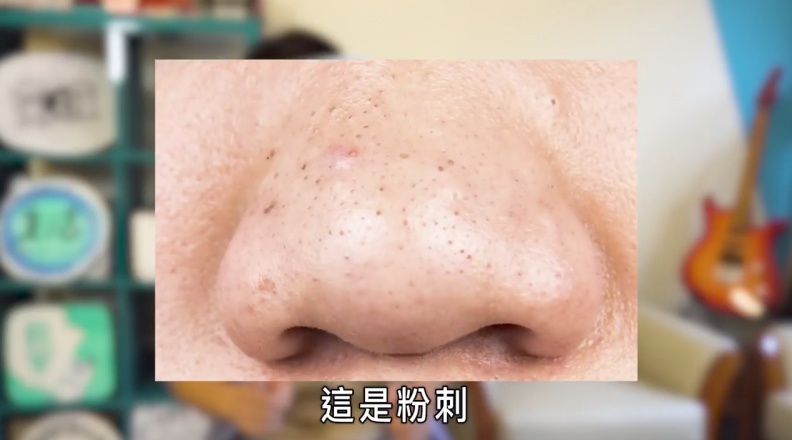 妳超愛拔粉刺的爽感？別傻了！其實妳拔的根本不是粉刺...