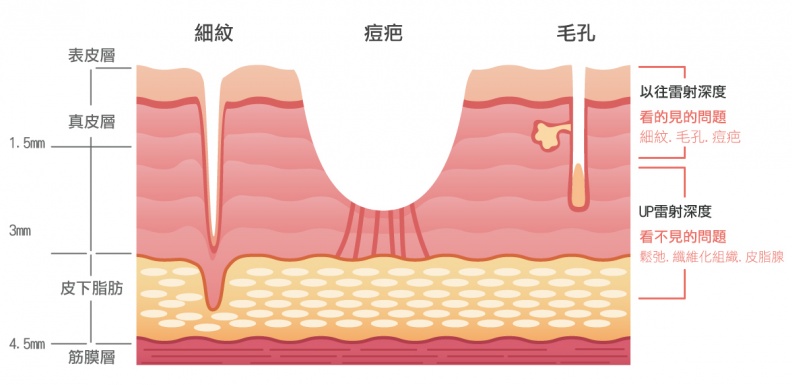 毛孔、細紋、凹疤要怎麼做才會變平？UltraPulse UP雷射，從此擺脫粗糙膚