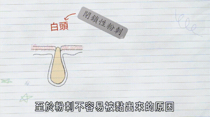 妳超愛拔粉刺的爽感？別傻了！其實妳拔的根本不是粉刺...
