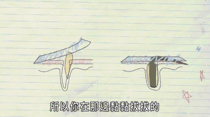 妳超愛拔粉刺的爽感？別傻了！其實妳拔的根本不是粉刺...