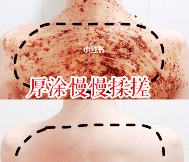 長背痘區域＝身體狀況指標！「5招」去背痘、消痘印超有感