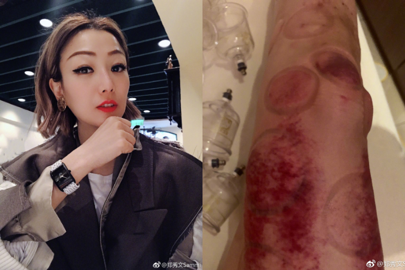 明星們熱愛的「刮痧」到底多神奇！養生又甩肉，一周腿圍速減3公分