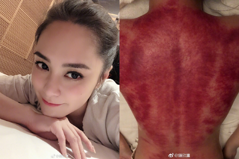 明星們熱愛的「刮痧」到底多神奇！養生又甩肉，一周腿圍速減3公分