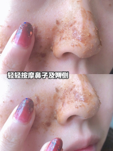 超平價去黑頭3步驟，還你嬰兒肌！惱人草莓鼻一次擊退不再來