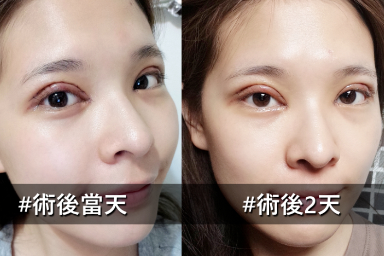 好想有雙眼皮喔！割還是縫呢？醫生說：搞懂這些事才能有迷人電眼