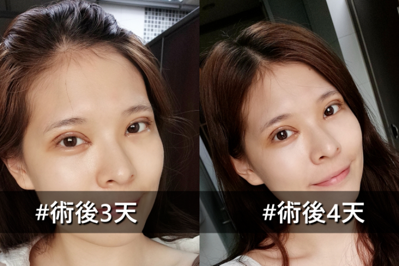 好想有雙眼皮喔！割還是縫呢？醫生說：搞懂這些事才能有迷人電眼