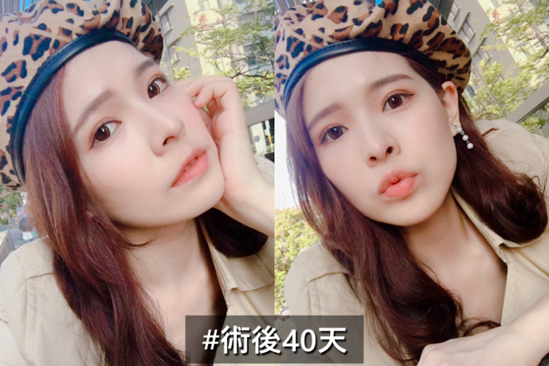 好想有雙眼皮喔！割還是縫呢？醫生說：搞懂這些事才能有迷人電眼