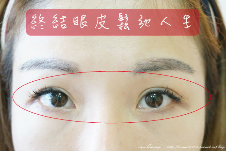 好想有雙眼皮喔！割還是縫呢？醫生說：搞懂這些事才能有迷人電眼