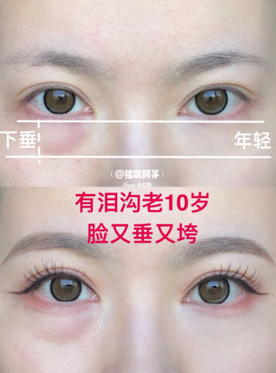 FotoJet (6) - FotoJet (6).jpg 黑眼圈、淚溝讓你老10歲!3步驟隱形術快學起來,效果竟比修圖還神奇