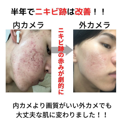 只花半年就治好滿臉痘痘！日男「真實抗痘經驗」分享，關鍵：改變洗臉方式