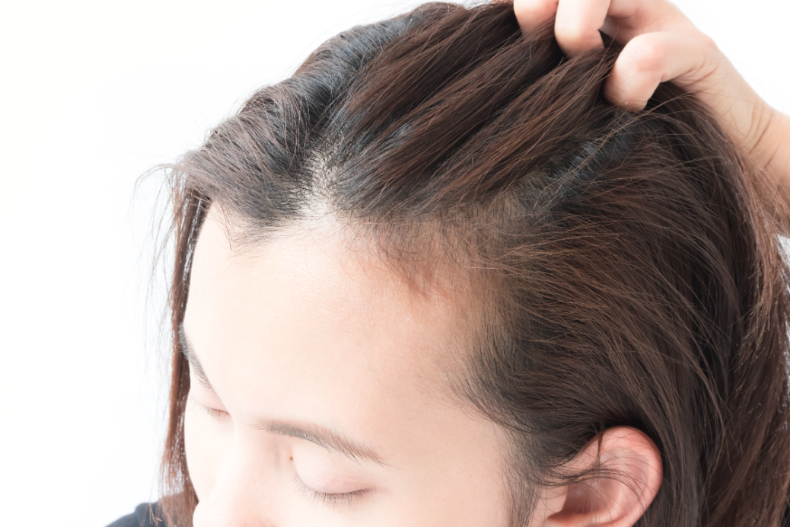 髮際線倒退嚕?3原因導致你加速掉髮!正常掉髮量超過「這數字」就要小心