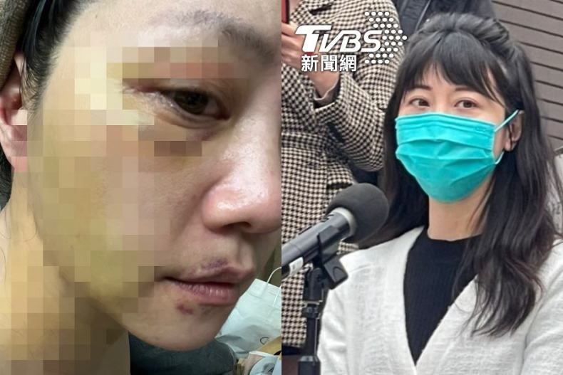 心疼！高嘉瑜遭男友暴打全身傷！律師教你３步驟自保「遇恐怖情人怎麼辦？」