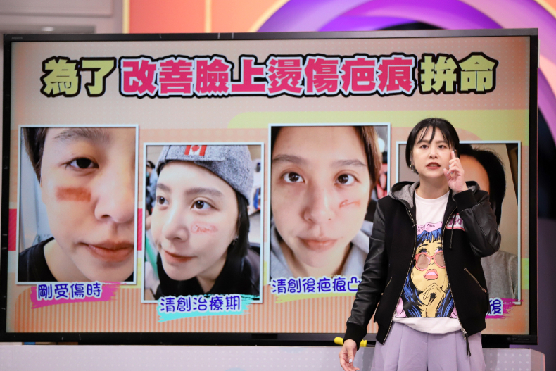 ▲黃小柔層身受臉不燙傷所苦