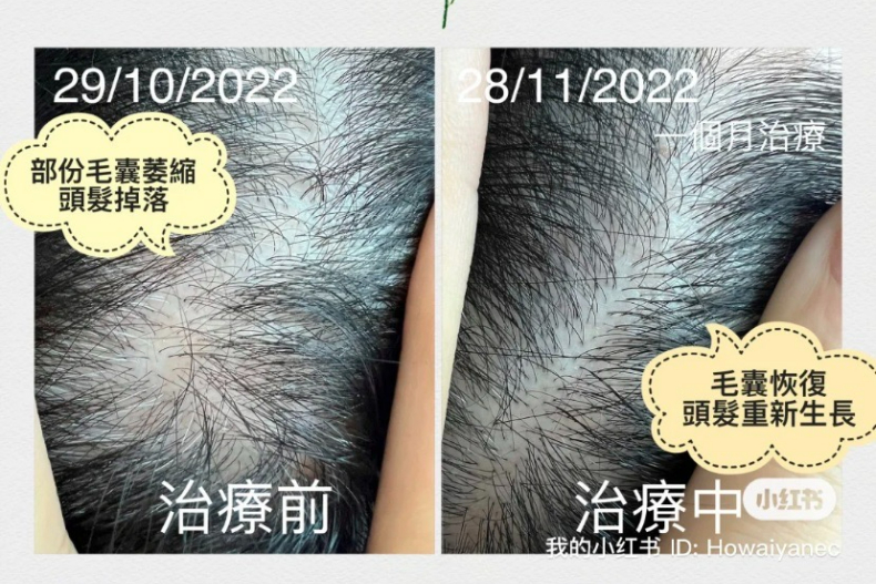 60＋白髮轉黑真的可以！中醫師分享「合補腎烏髮茶」＋2種調理方式，頭髮變黑還瘋長