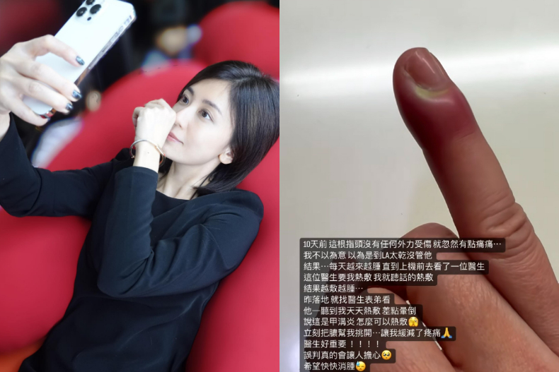 賈靜雯遭醫師誤判，嚴重將導致指甲脫落！熱衷美甲、指甲剪太短、愛咬指甲需注意