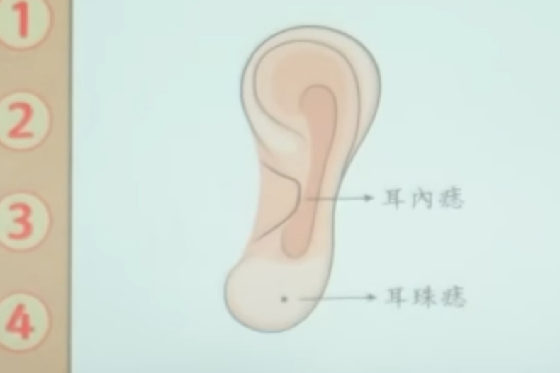 「愛財如命」面相3. 耳朵有痣 非富則貴