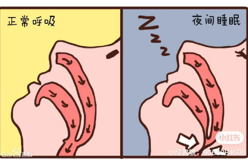 打呼聲背後的驚人真相：「睡眠呼吸中止症」竟是健康的殺手，小心引起心血管和糖尿病問題