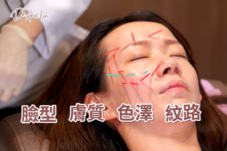 媲美無痛音波電波的「中醫美顏針」是什麼？跟針灸有何不同？中醫師林芷瑜來解答
