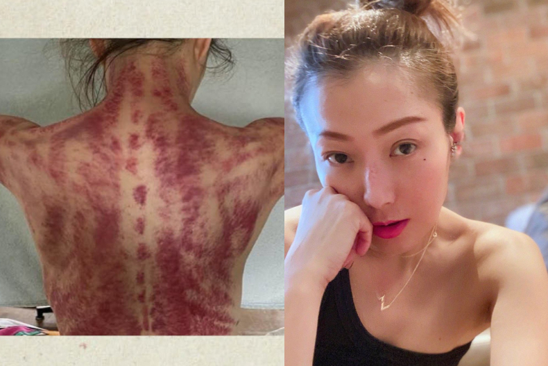 鄭秀文熱愛的刮痧，能幫助減重、改善水腫橘皮？中醫師來回答