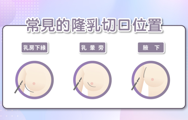 丹妮婊姐、李宓都大方認隆乳！隆乳形狀材質怎麼挑？切口位置怎麼選？邱大睿醫師來回答
