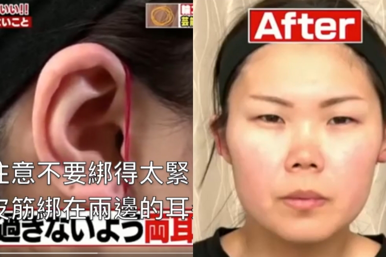 橡皮筋瘦臉法有效嗎？